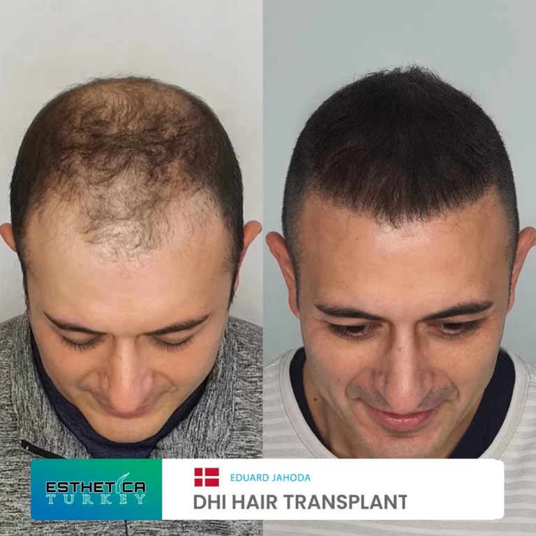 ESTHETİCA before after (1)