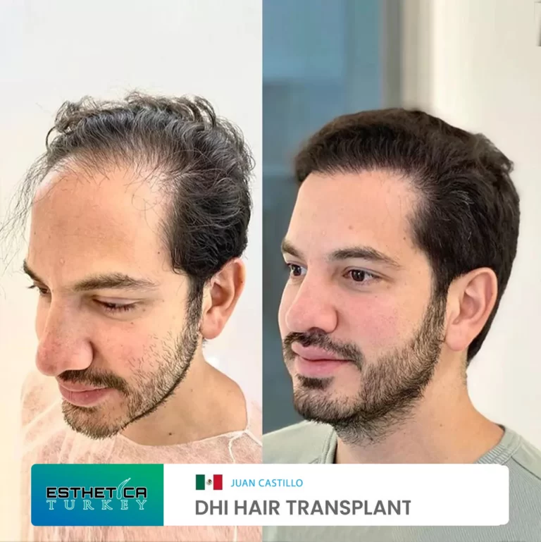 ESTHETİCA before after (10)