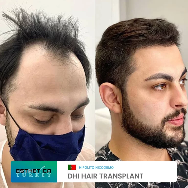 ESTHETİCA before after (11)