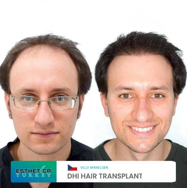 ESTHETİCA before after (2)