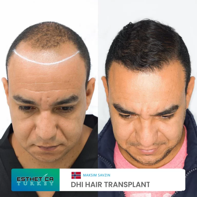 ESTHETİCA before after (3)