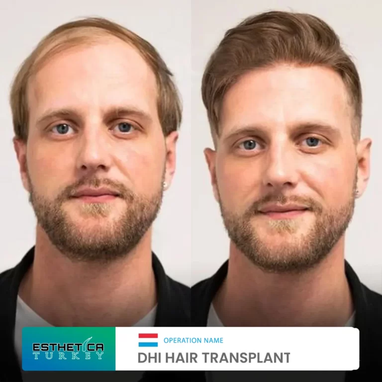 ESTHETİCA before after (4)