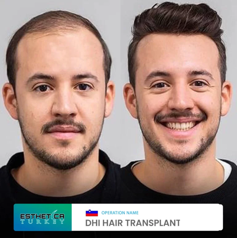 ESTHETİCA before after (5)