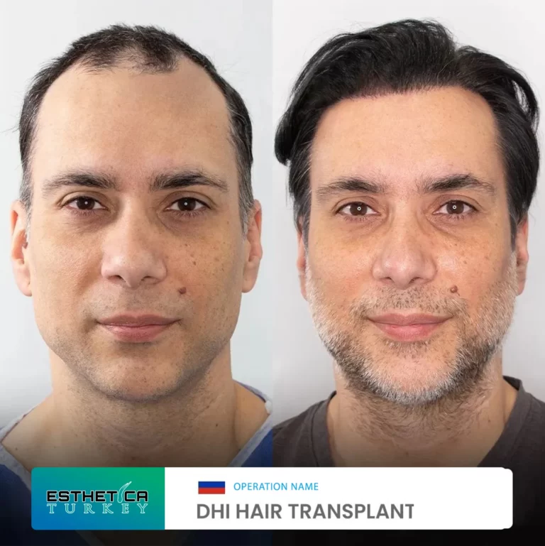 ESTHETİCA before after (6)