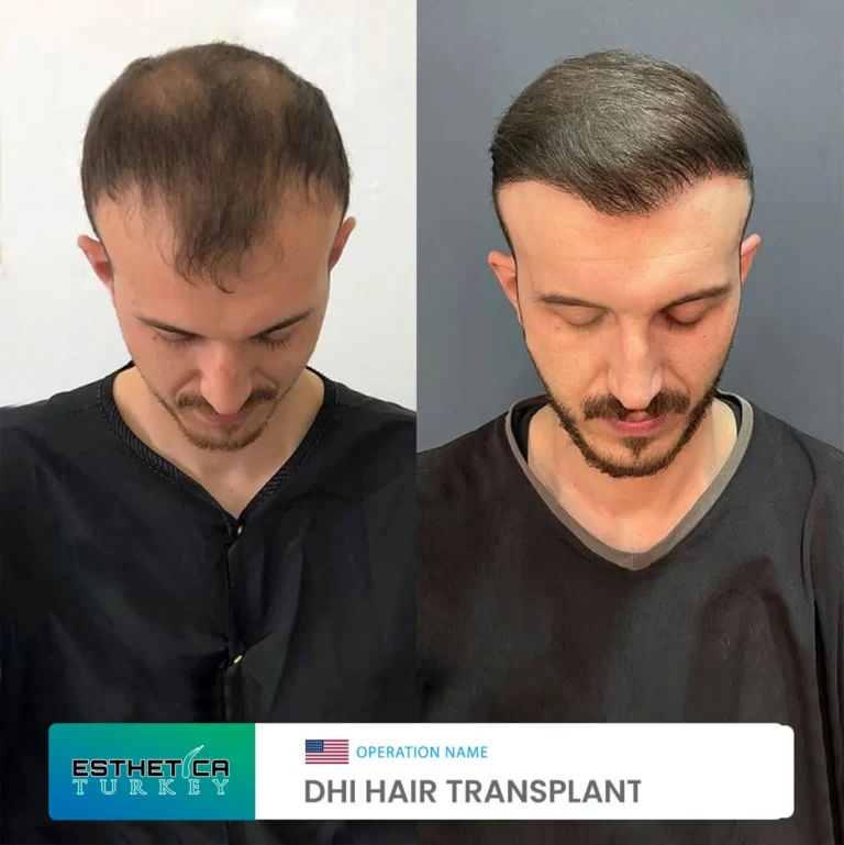 ESTHETİCA before after (8)