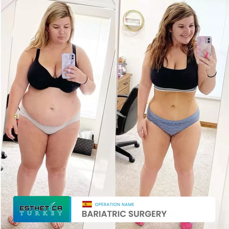 ESTHETİCA before after bariatric (4)
