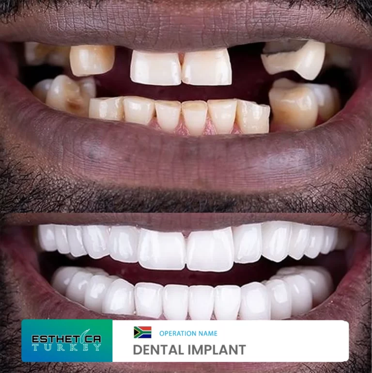 ESTHETİCA before after dentistry (10)