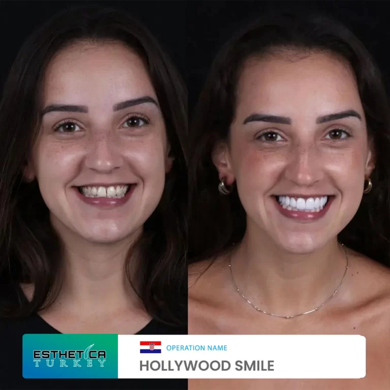 ESTHETİCA before after dentistry (12)