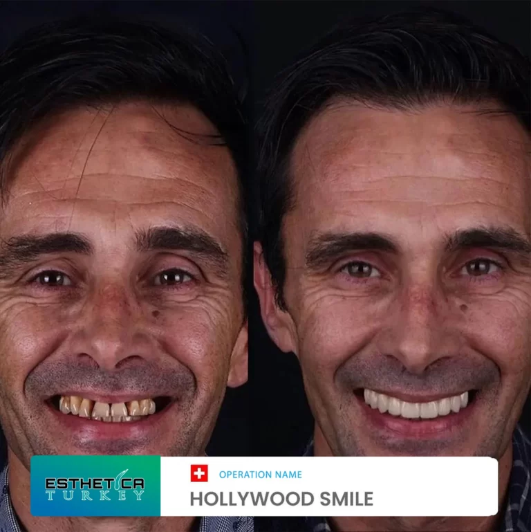 ESTHETİCA before after dentistry (13)