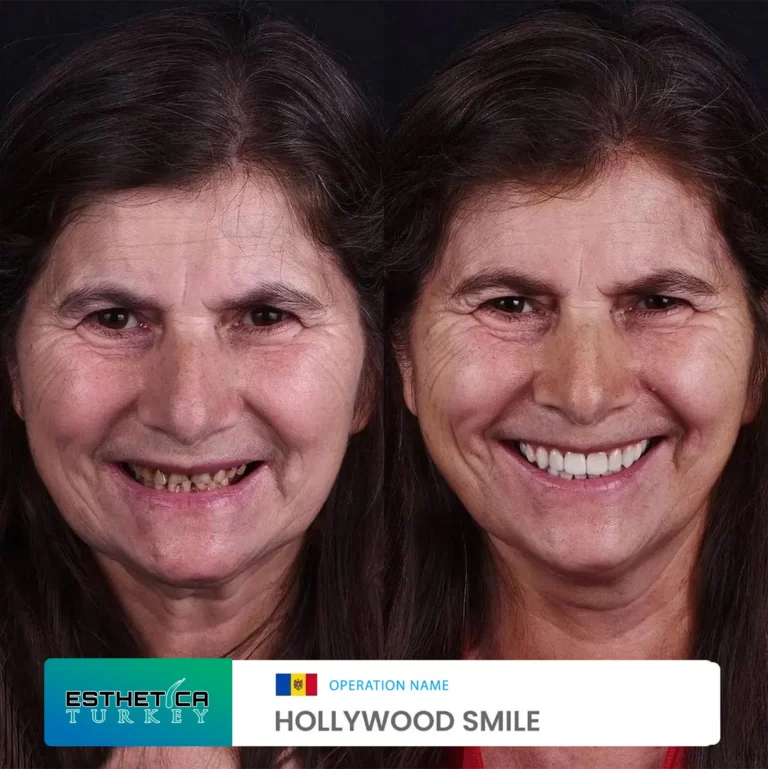 ESTHETİCA before after dentistry (14)
