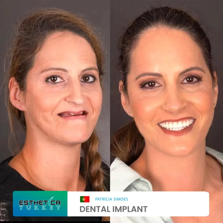 ESTHETİCA before after dentistry (15)