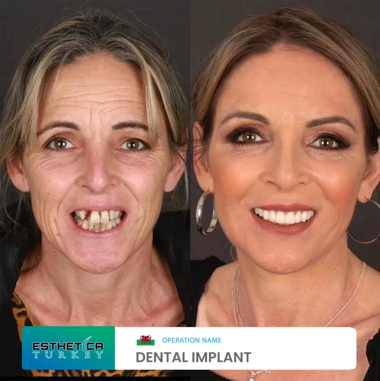 ESTHETİCA before after dentistry (2)