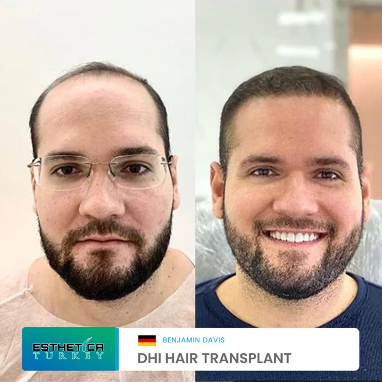 ESTHETİCA before after dentistry (3)