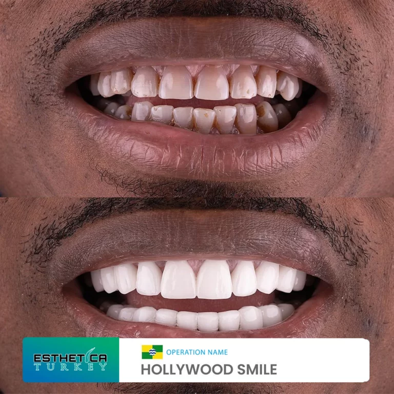 ESTHETİCA before after dentistry (4)