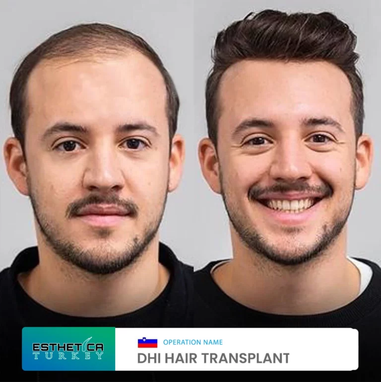 ESTHETİCA before after dentistry (5)