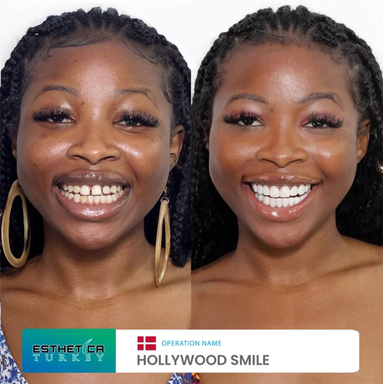 ESTHETİCA before after dentistry (6)