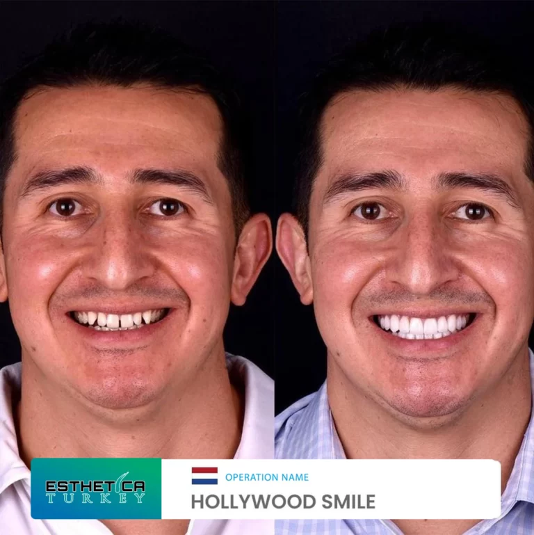 ESTHETİCA before after dentistry (7)