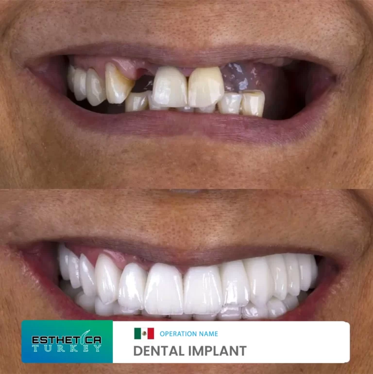 ESTHETİCA before after dentistry (8)