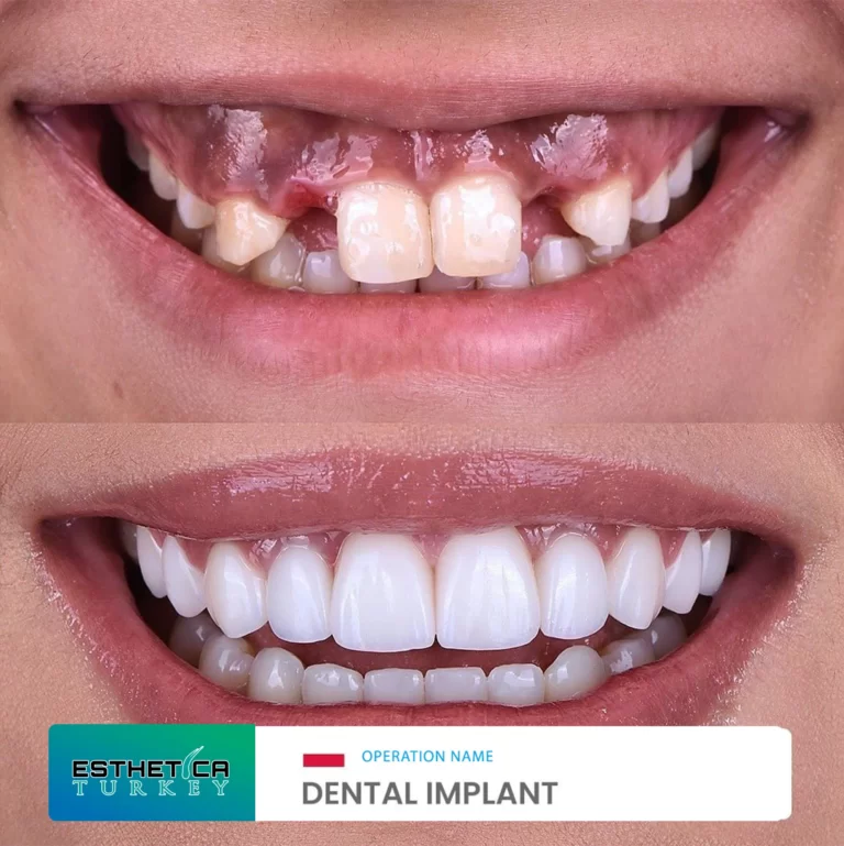 ESTHETİCA before after dentistry (9)