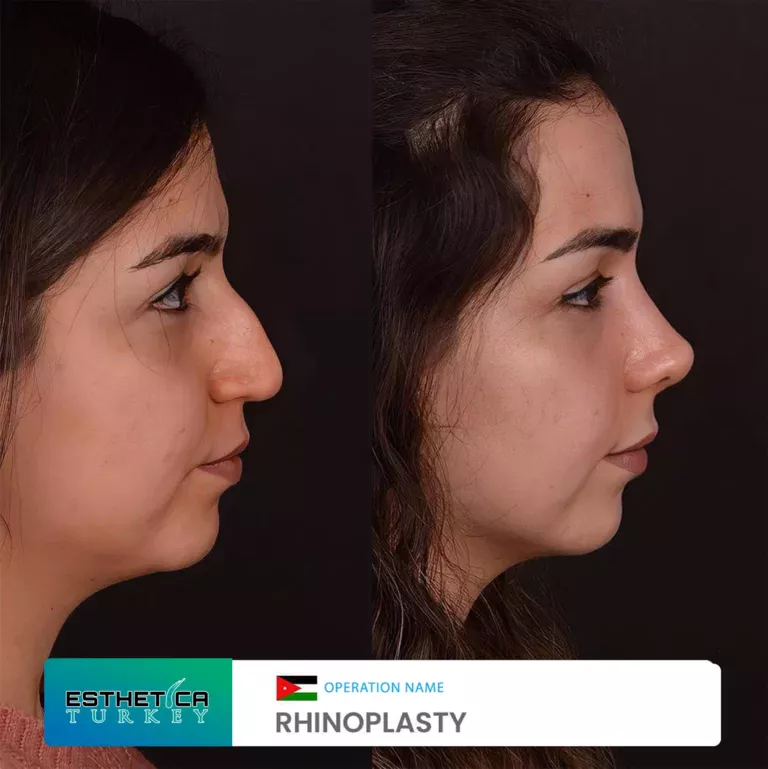 esthetica before after face estetic (1)