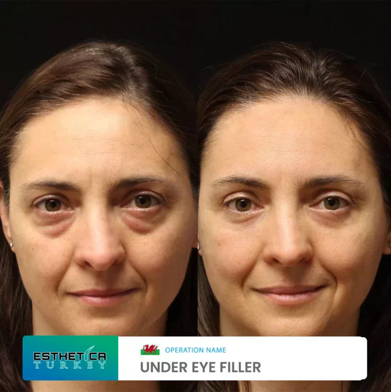 esthetica before after face estetic (2)