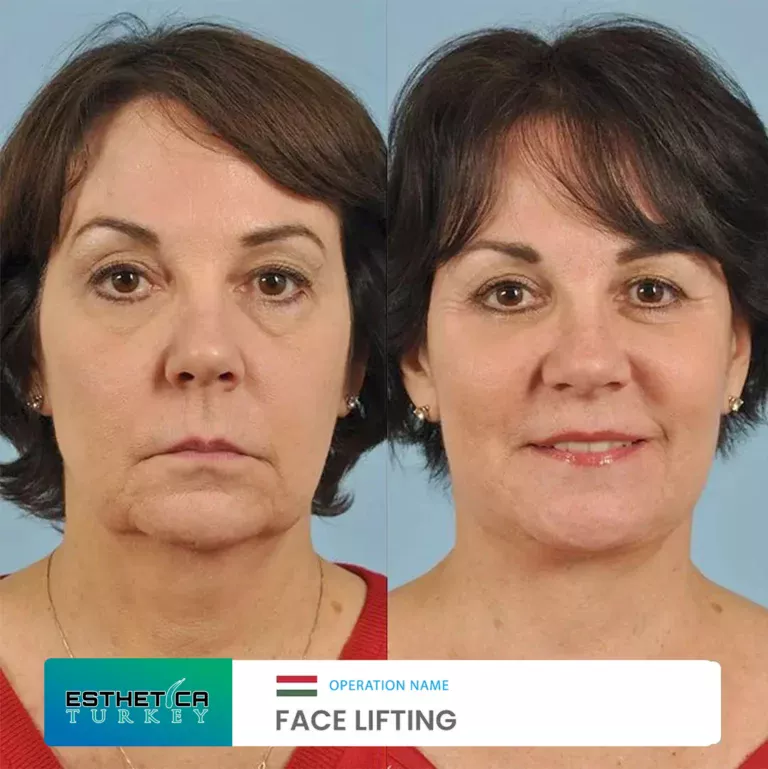 esthetica before after face estetic (8)