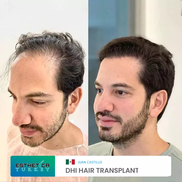 ESTHETİCA before after (10)