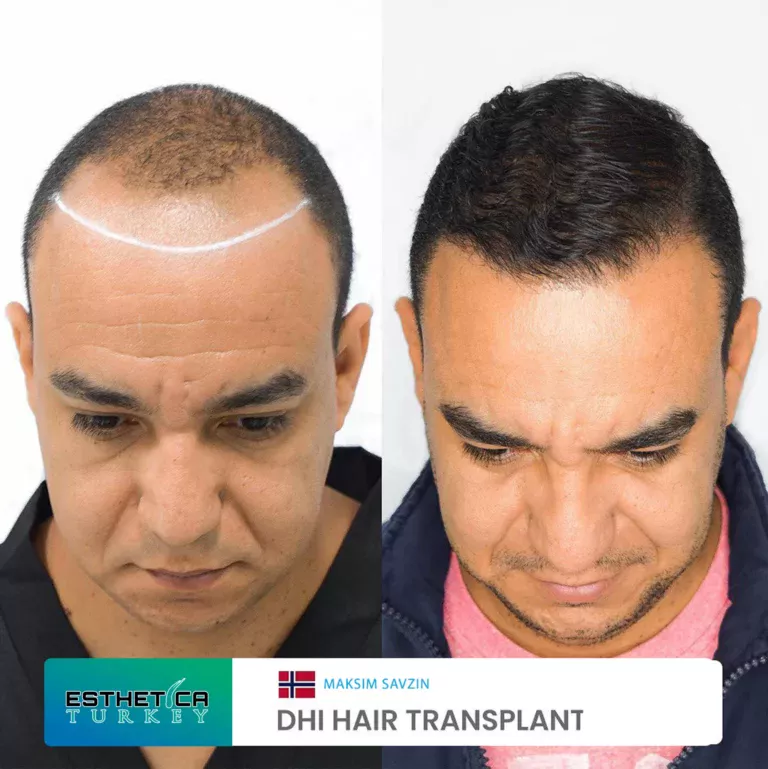 ESTHETİCA before after (3)