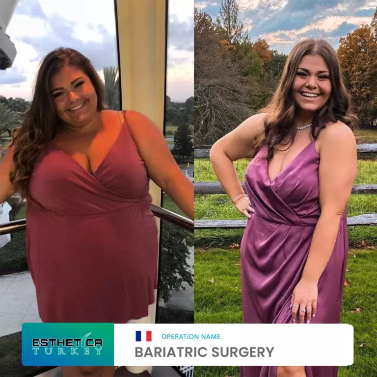 ESTHETİCA before after bariatric (3)