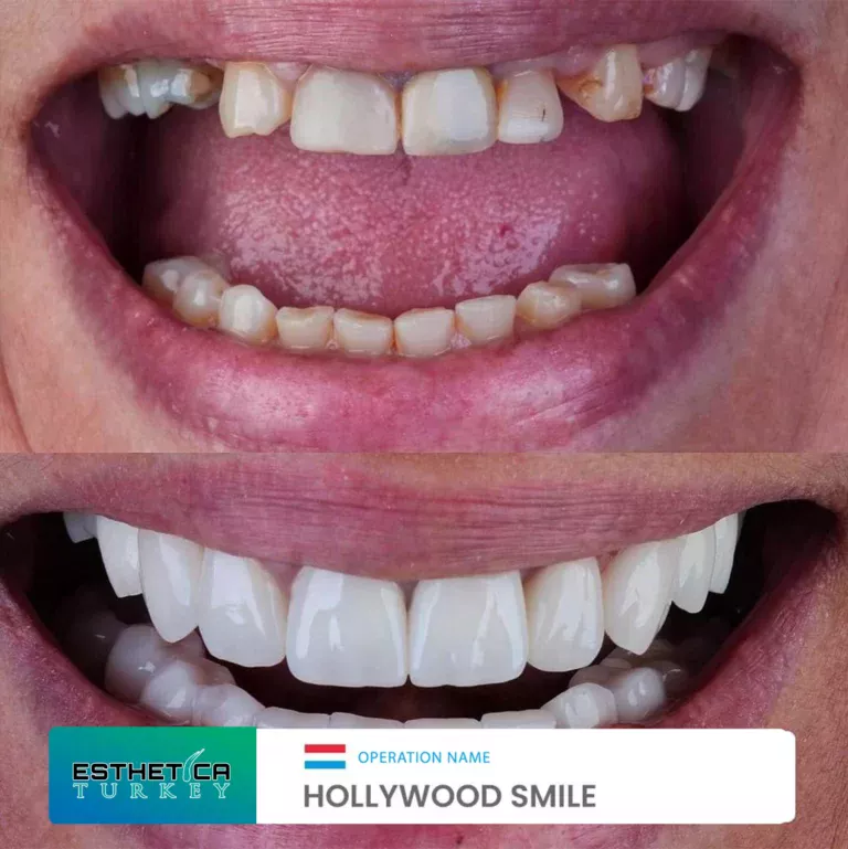 ESTHETİCA before after dentistry (11)