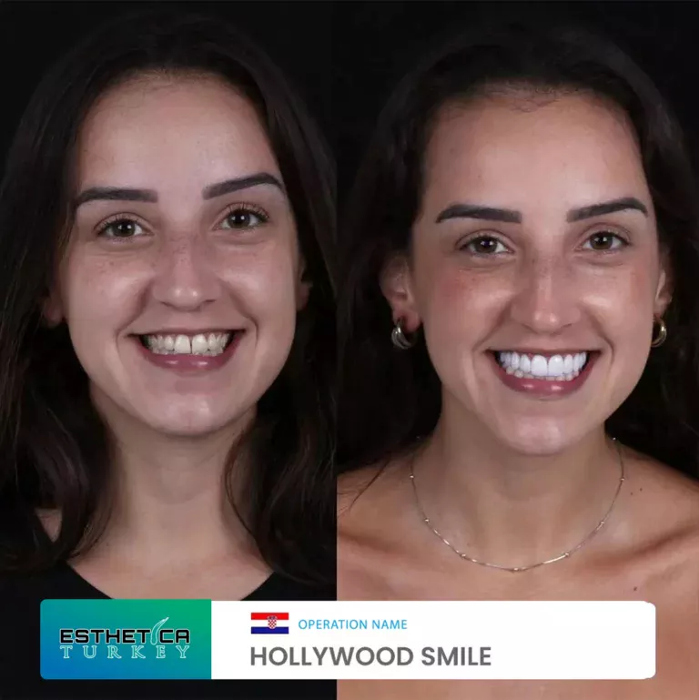 ESTHETİCA before after dentistry (12)