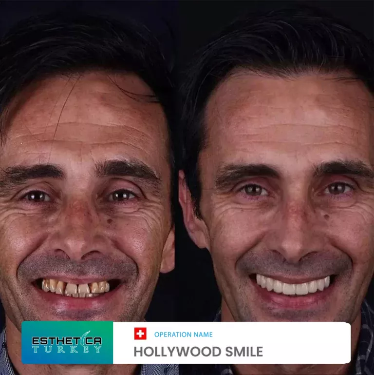 ESTHETİCA before after dentistry (13)