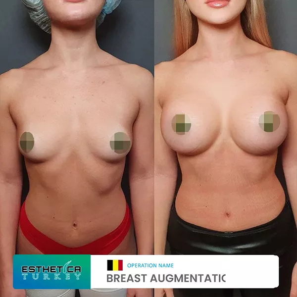 estetica clinic before after breat treatments (10)
