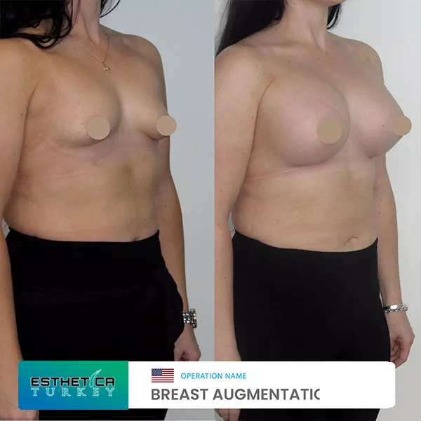 estetica clinic before after breat treatments (5)