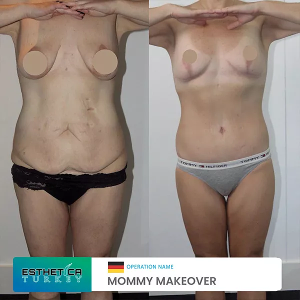 estetica clinic before after breat treatments (9)