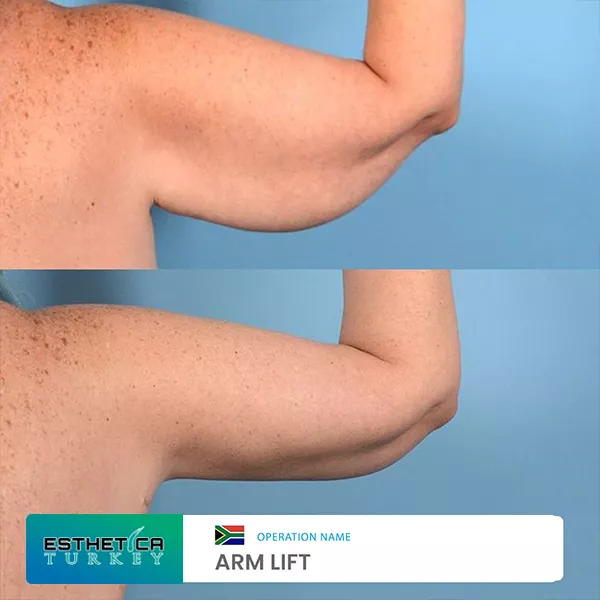 estetica plastic surgery before after (1)