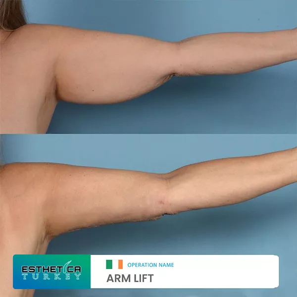 estetica plastic surgery before after (11)