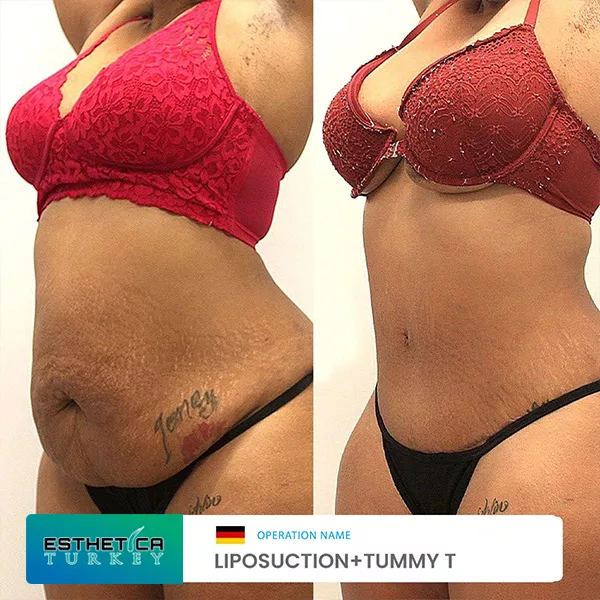 estetica plastic surgery before after (12)