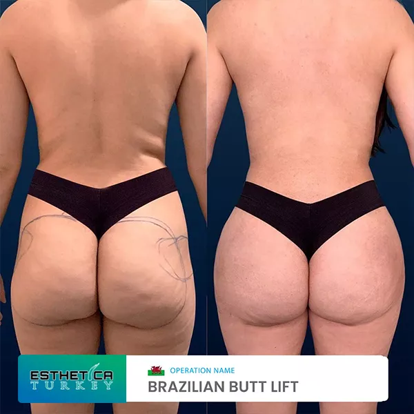 estetica plastic surgery before after (14)