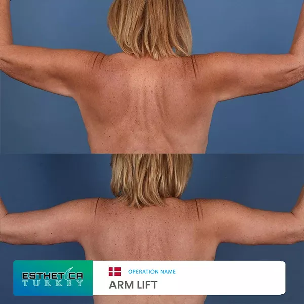 estetica plastic surgery before after (2)