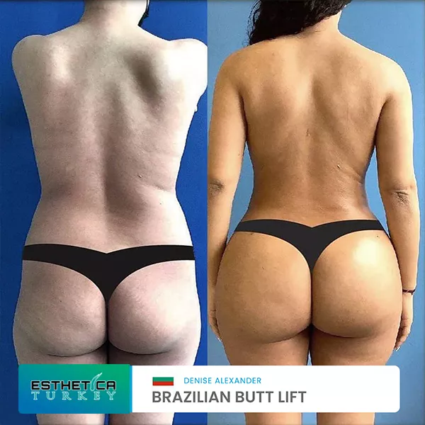 estetica plastic surgery before after (20)