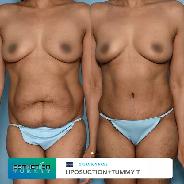 estetica plastic surgery before after (5)