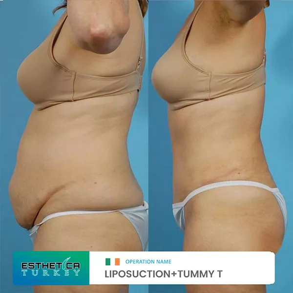 estetica plastic surgery before after (6)
