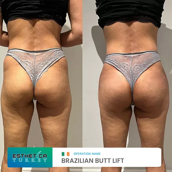 estetica plastic surgery before after (7)