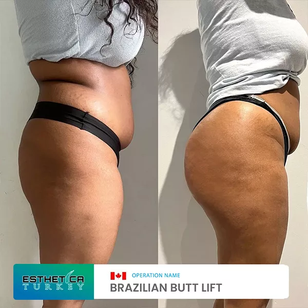 estetica plastic surgery before after (8)